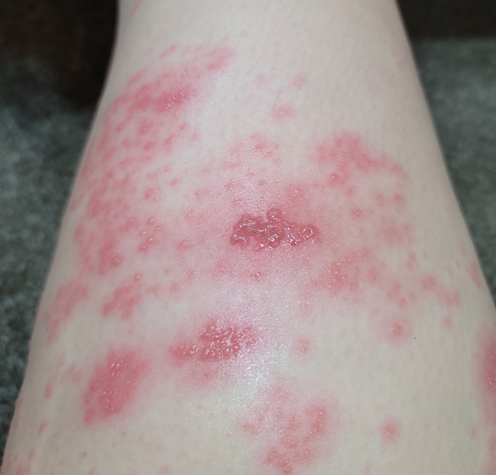 帯状疱疹（皮膚のピリピリした痛み・水疱・発疹）